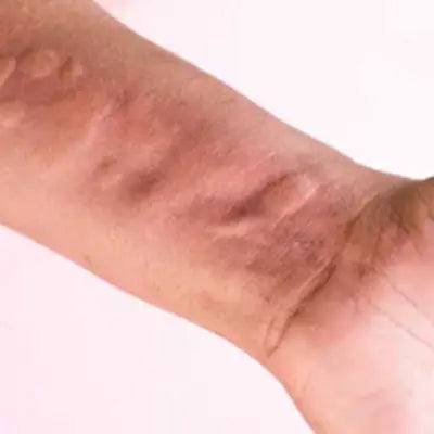 Allergic Itch and Hives