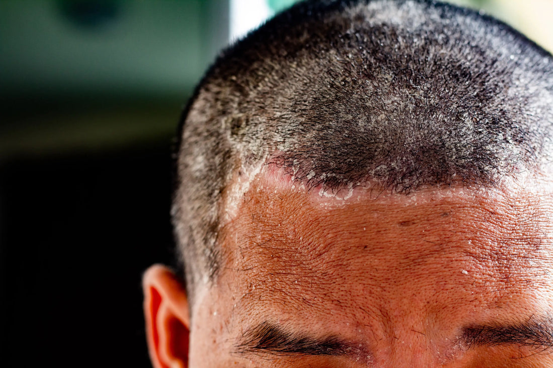 Scalp Itch: Get Relief From Your Itchy Scalp