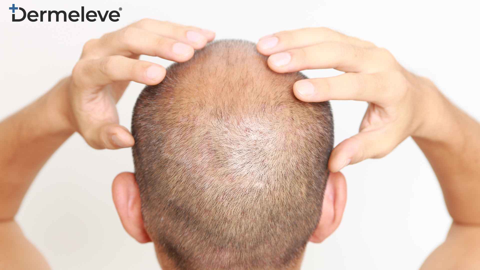 走向救济！如何应对头皮酵母菌感染– Dermeleve®, image size:1920x1080