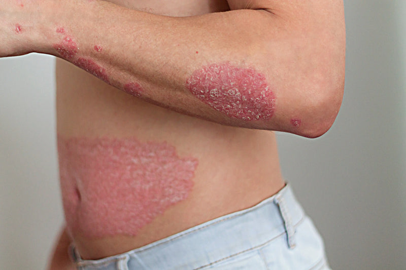 What is Psoriasis
