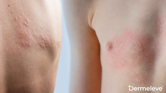 Hives vs Rash featured image