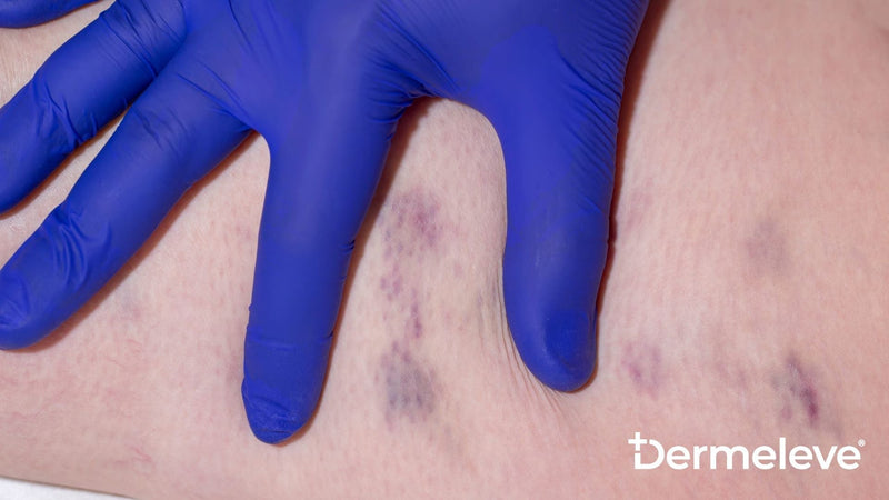 Venous Staris Featured Image