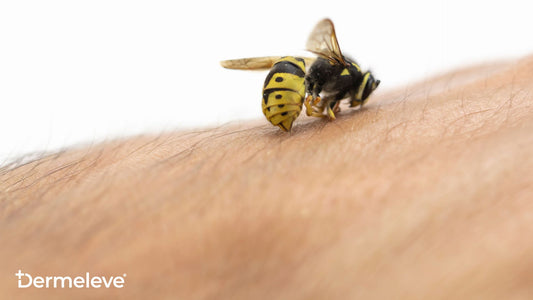 How to Treat a Bee or Wasp Sting if it's Still Swelling After 48 Hours - featured image