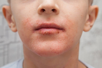 Understanding Eczema: Causes, Types, Symptoms & Relief