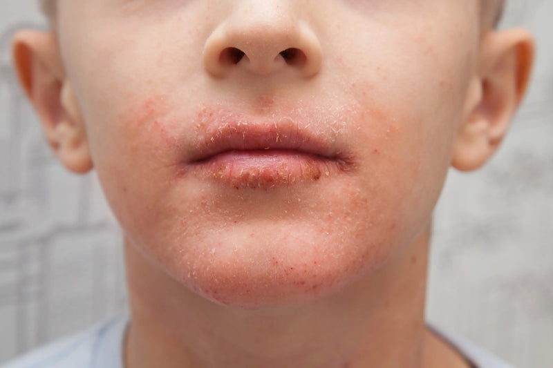 Understanding Eczema: Causes, Types, Symptoms & Relief