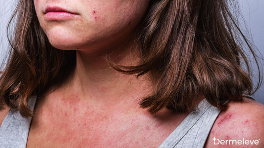 Eczema Flare Ups - Featured Image