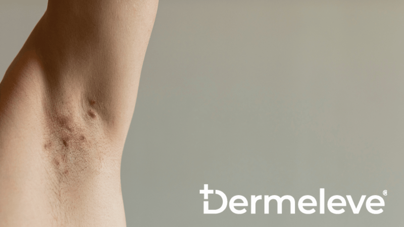 Can GLP-1 Drugs Ease the Pain of Hidradenitis Suppurativa? Here’s What the Research Says