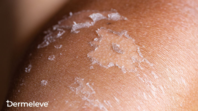 Hell's Itch - featured image