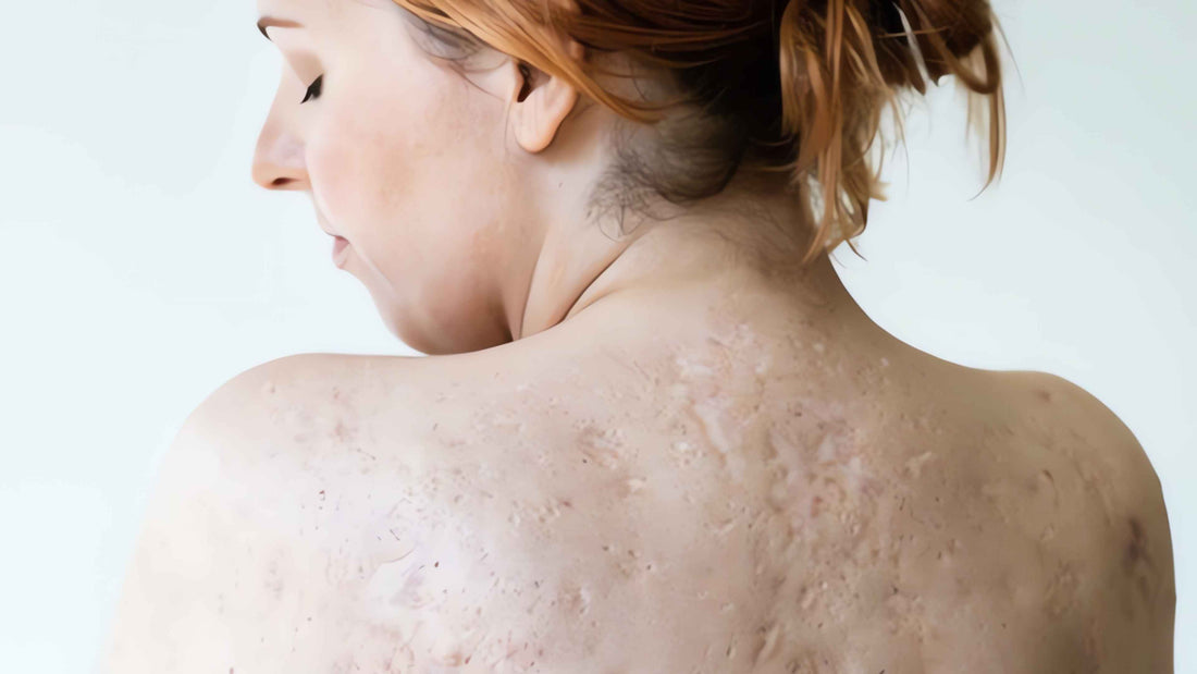 Pictures of hidradenitis suppurativa featured image