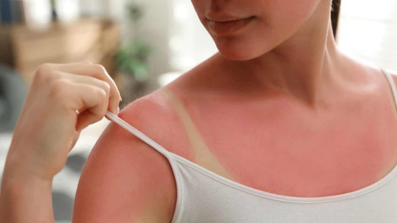 Is it Safe to Use Hydrocortisone for Sunburns?