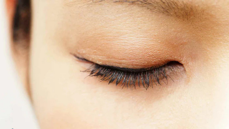 Itchy Eyelids (Eyelid Dermatitis & Ocular Pruritus): Causes, Symptoms, and Relief