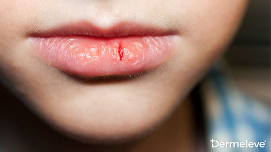 Lip Eczema Featured Image