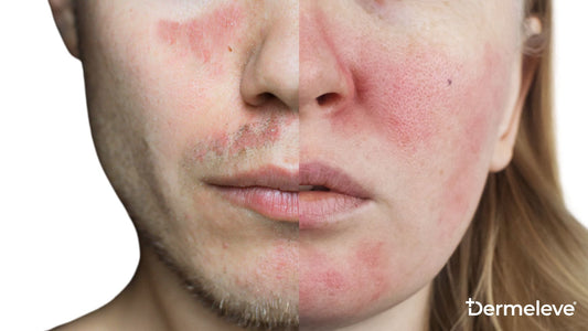 Lupus Rash vs. Rosacea