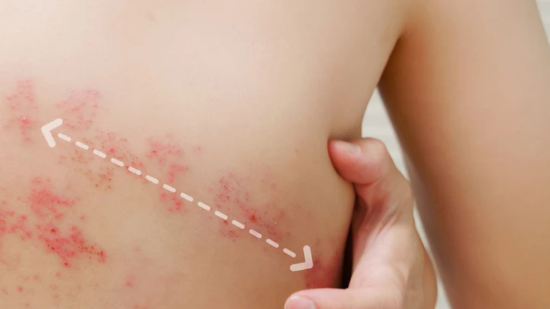 Nerve Paths That Shingles Follow: Dermatomes and Herpes Zoster