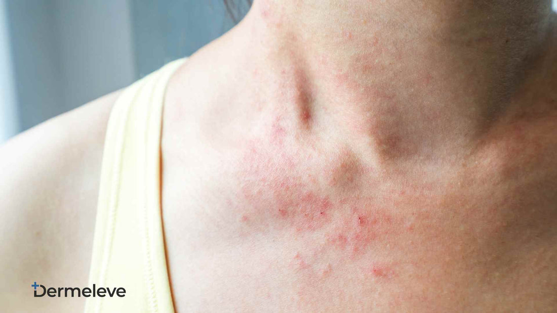 Nickel Allergy Featured image