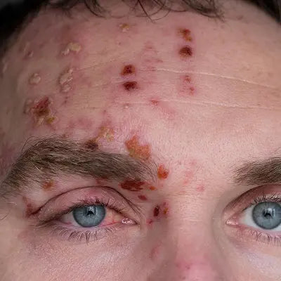 Shingles: Symptoms, Causes, and Treatment