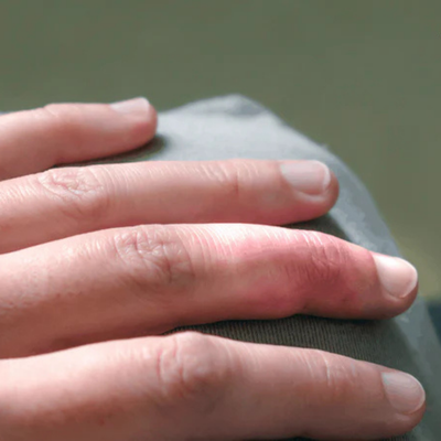 Soft Tissue Mallet Finger: Causes, Symptoms, and Relief for Nerve Itch