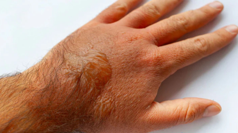 Treatment for Staphylococcal Scalded Skin Syndrome (SSSS)