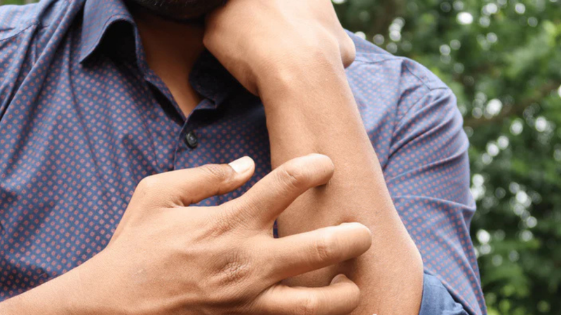 Understanding the Hidden Symptom of Hidradenitis Suppurativa (HS) and How Strontium Cream Offers Relief