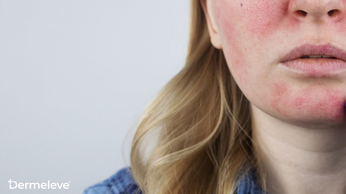 The Different Types of Rosacea