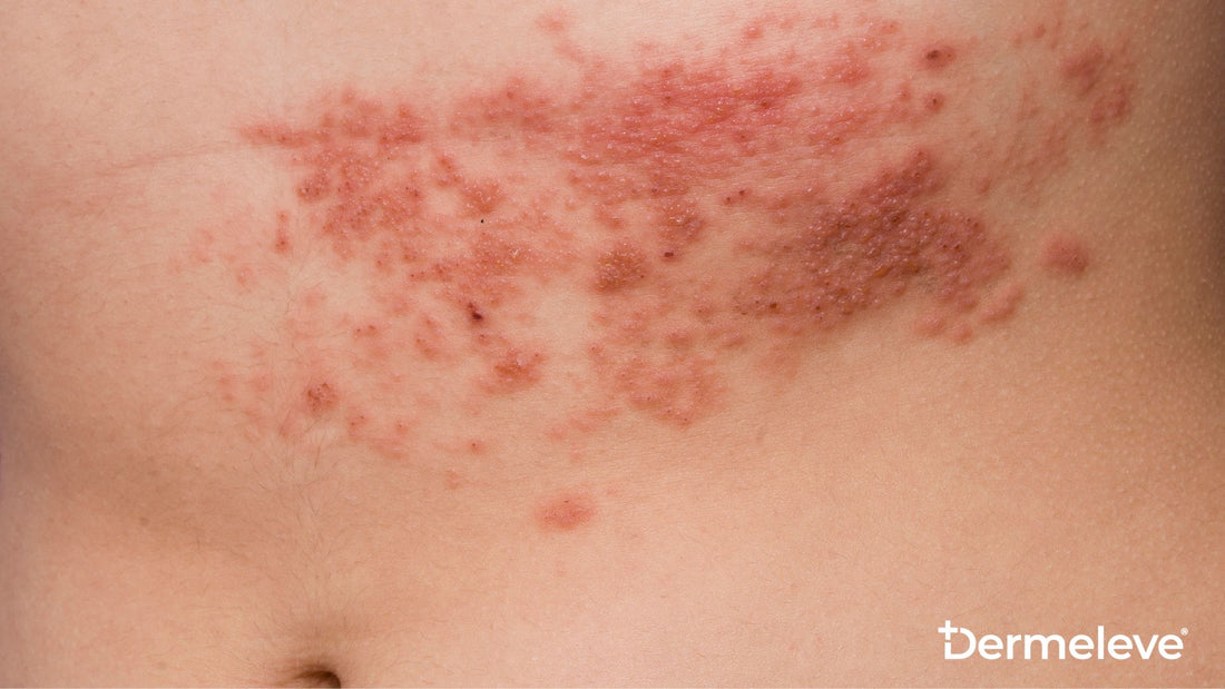 What are the stages of shingles - featured image