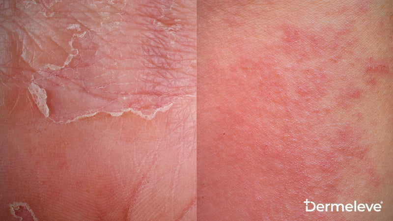 Eczema vs. Prosiasis