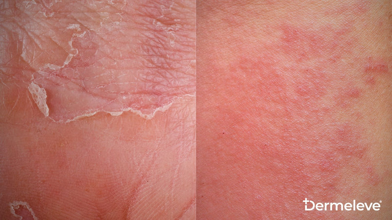 Eczema vs. Prosiasis