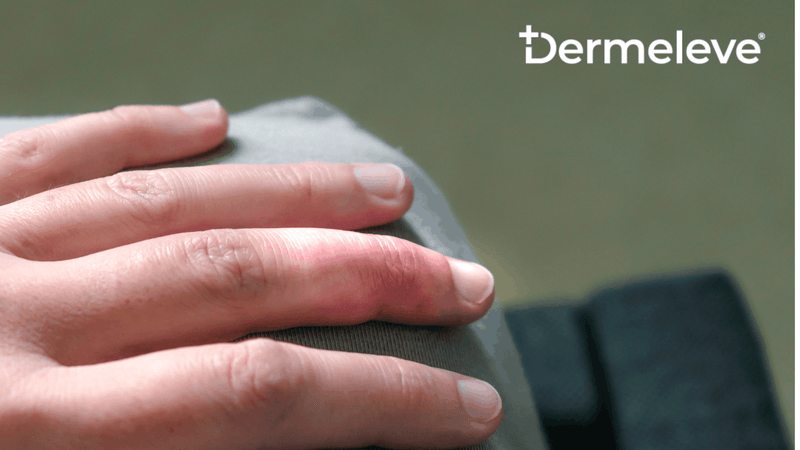 Soft Tissue Mallet Finger: Causes, Symptoms, and Relief for Nerve Itch